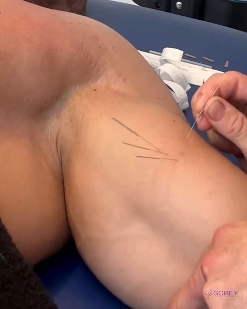 Dry needling on a shoulder muscle